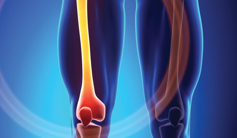 Bone Health Blood Test in Leicester
