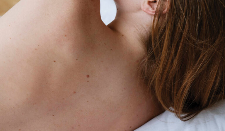 Cryotherapy Treatment in Leicester